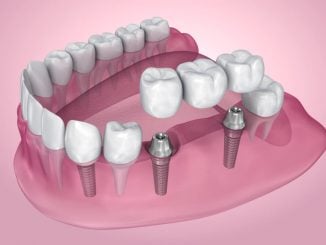 implant iyileştirme başlığı
